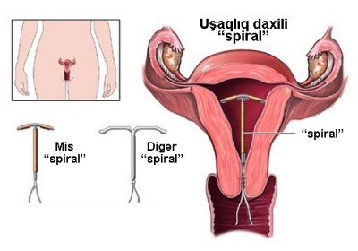 Usaqliq daxili spiral haqqinda bilmedikleriniz