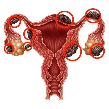Endometrioz nedir? Endometriozun elametleri